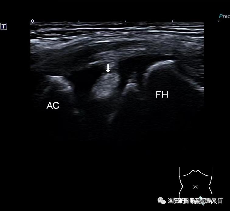 病例分享小儿髋关节滑膜嵌顿症