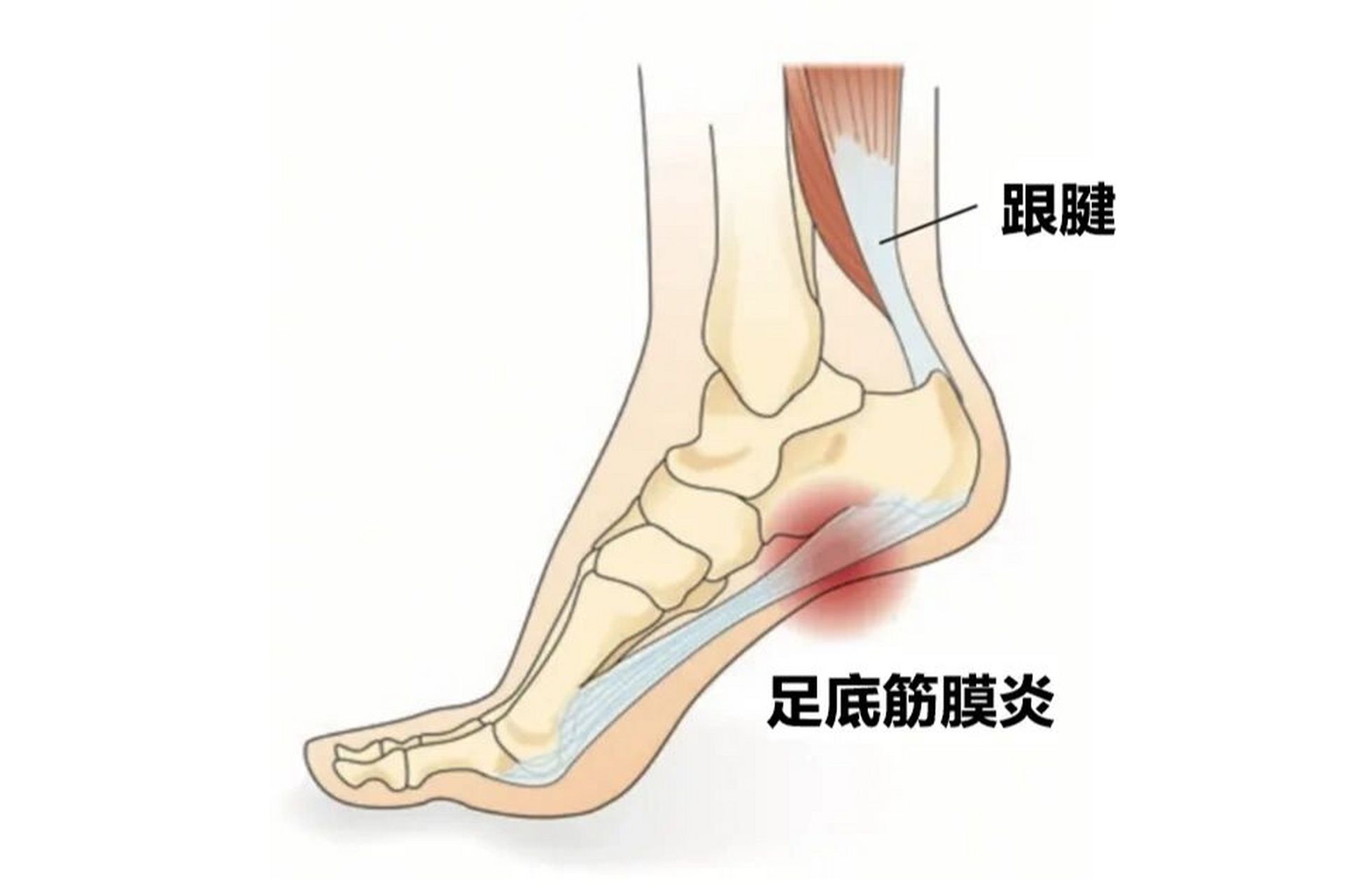 筋膜炎疼痛位置图片图片