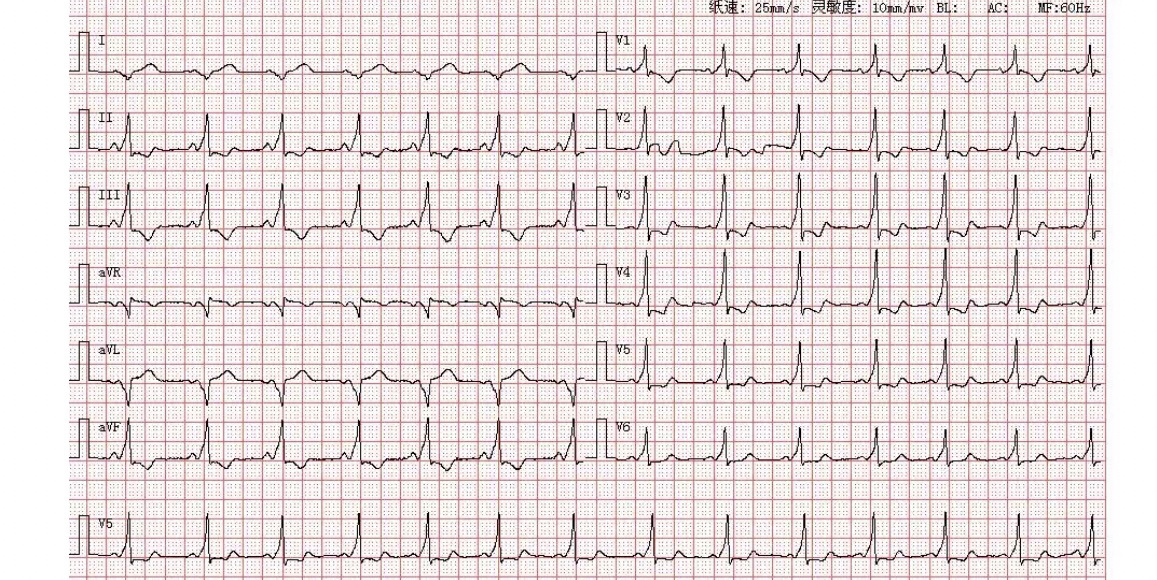 wpw综合症(a型) 分析:患者p波在l,ll,avf,v4-v6导联直立向上,avr导联