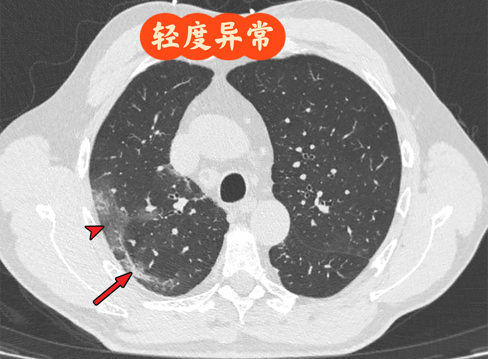 新冠病毒肺炎图片