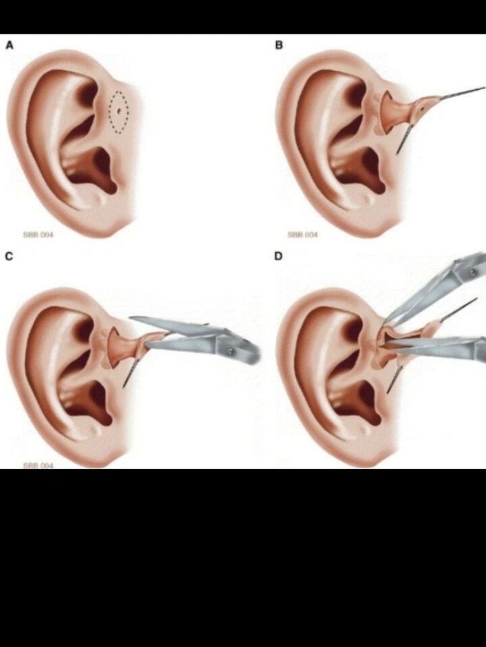 耳瘘管到底是什么病06 97耳前瘘管是先天性的耳部畸形,是由于患者