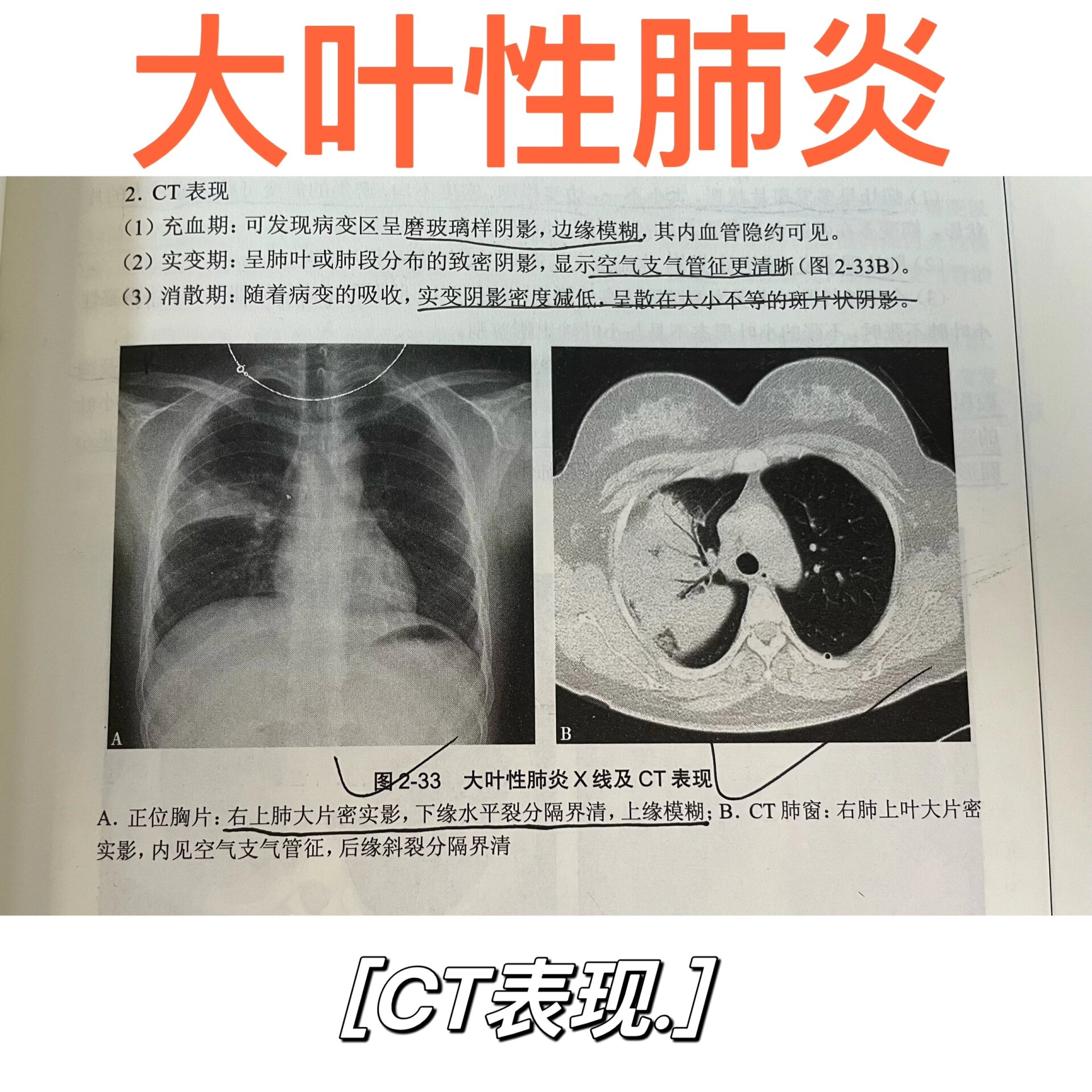 大叶性肺炎的影像学表现(x线 ct) 大叶性肺炎7815781578
