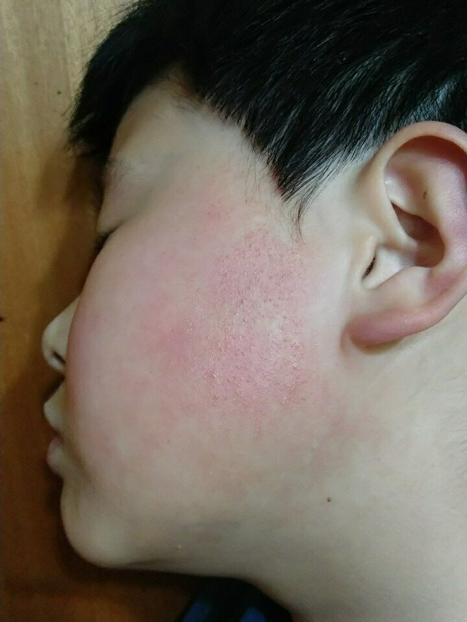 婴儿霜, 据说是治疗脸红,也不知道是否能治小孩基因型毛周角化的红脸
