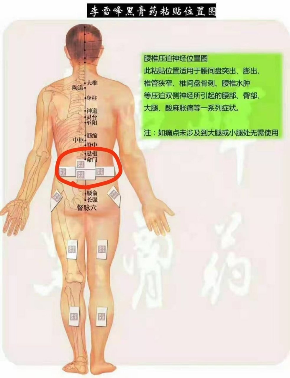 李雪峰黑膏药提醒你腰间盘就这么按穴位贴