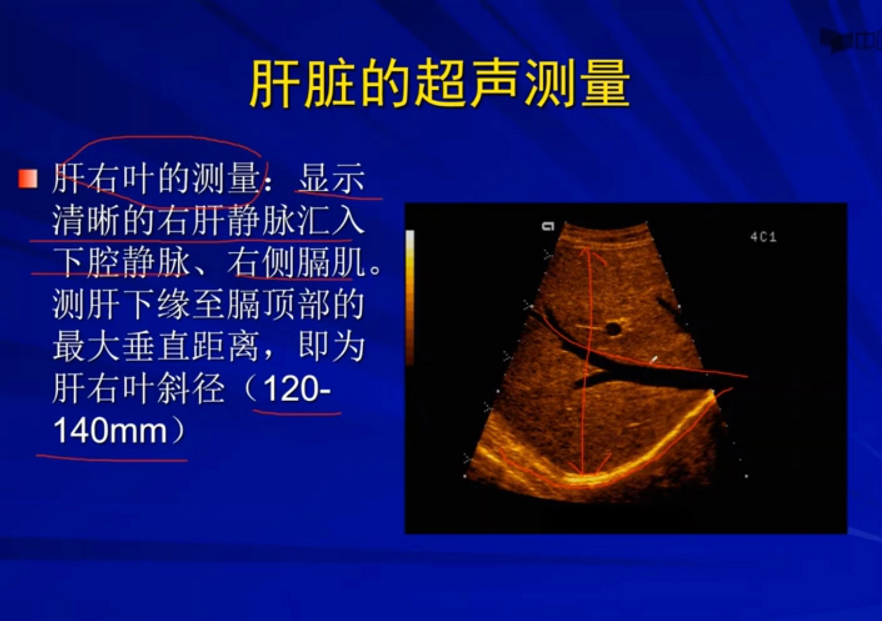 超声学习 7915肝脏扫查基础之超声解剖6015 99第二肝门斜