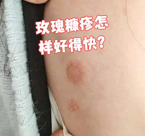 玫瑰糠疹是一种表现为躯干和四肢近端出现玫瑰色斑疹的皮肤病,疹子