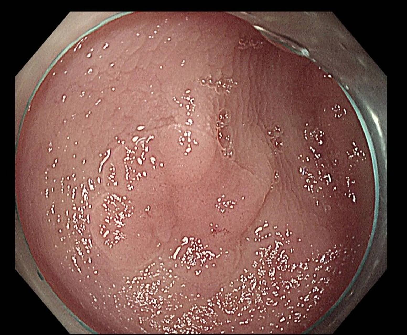 这样的结肠早期肿瘤发现一例就是拯救一命 这个也是一位老年患者,因为