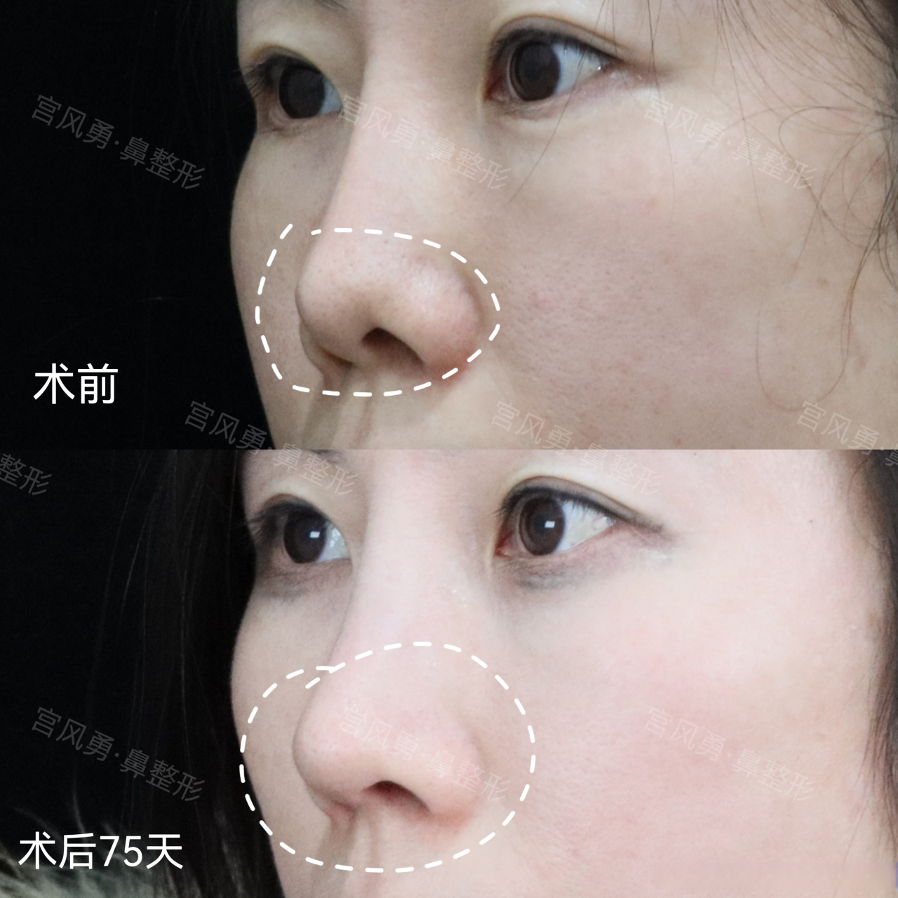 鼻翼缘挛缩修复 术后75天,之前做过l假体,鼻翼缘挛缩漏鼻孔,修复难点