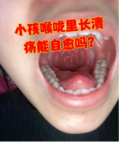 小孩喉咙里长溃疡能不能自己好,要看具体情况