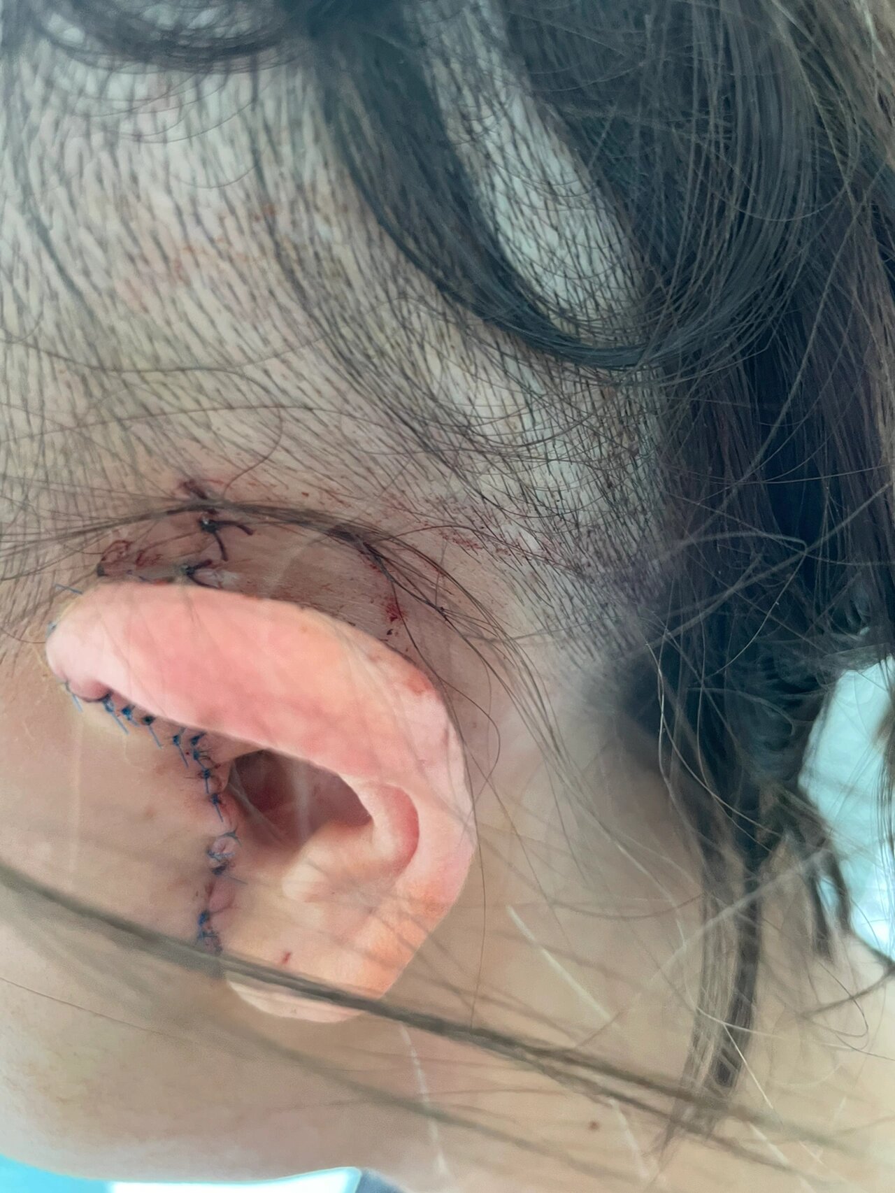 颞下颌关节手术恢复记录- day5  时间:10.