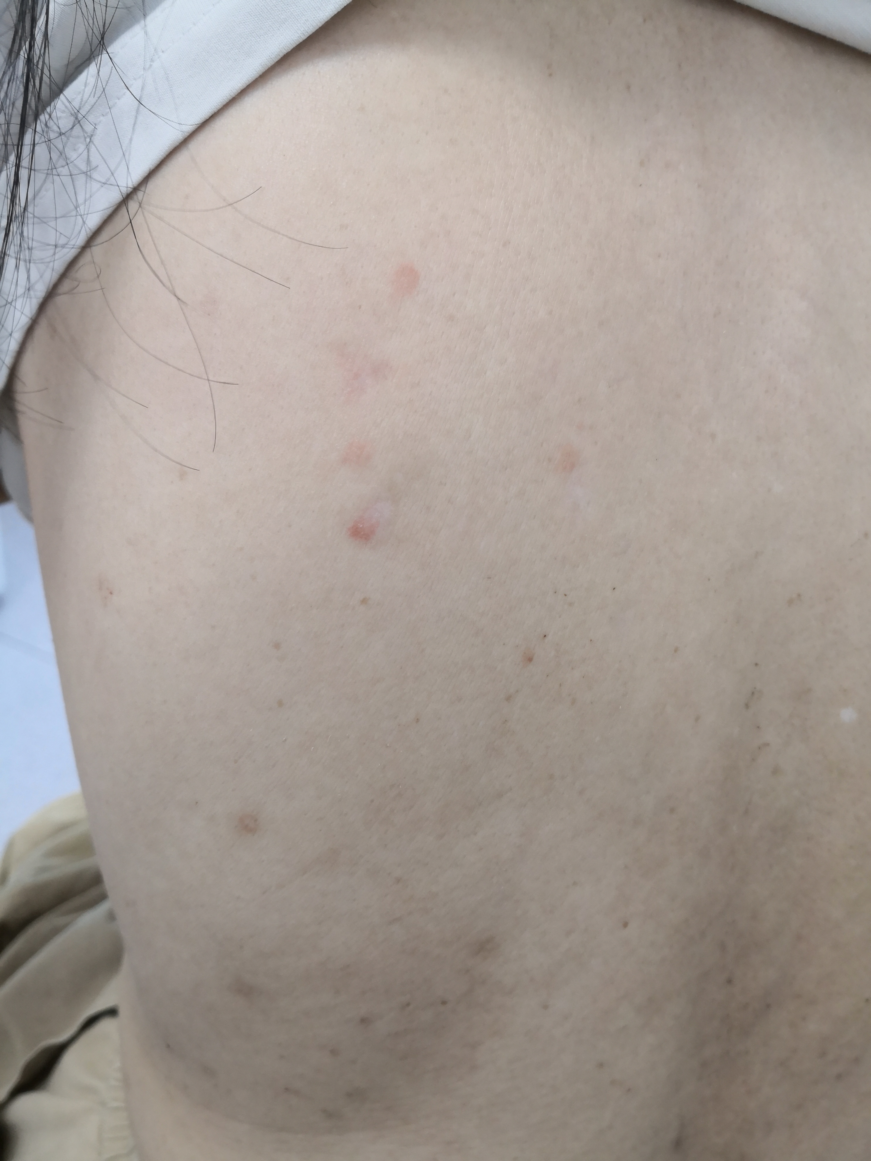 银屑病患者并发过敏症状.#银屑病##解决皮肤问题专注皮肤美容##过敏