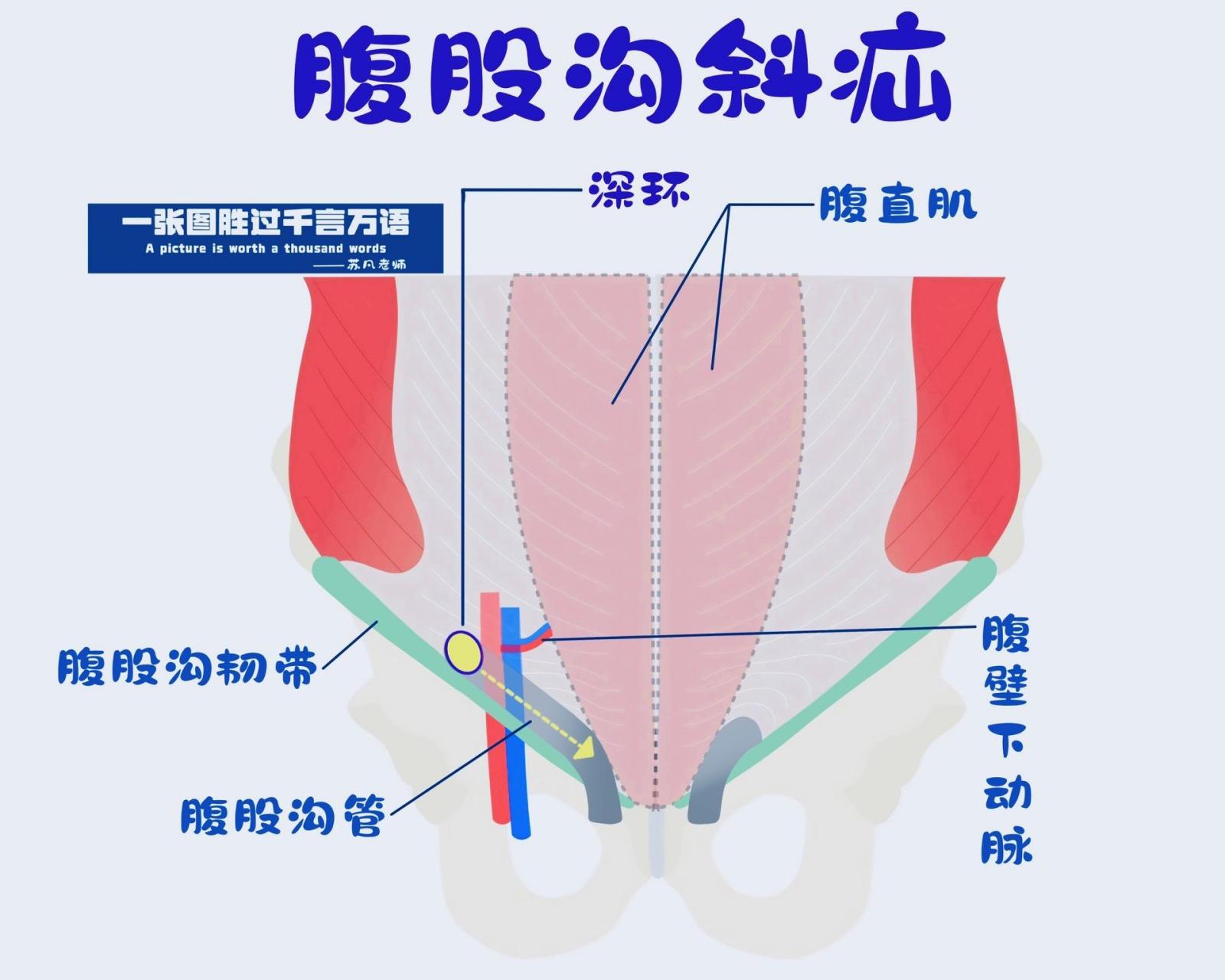 腹股沟疝(直疝&斜疝)直疝和斜疝简化版示意图来了哦!