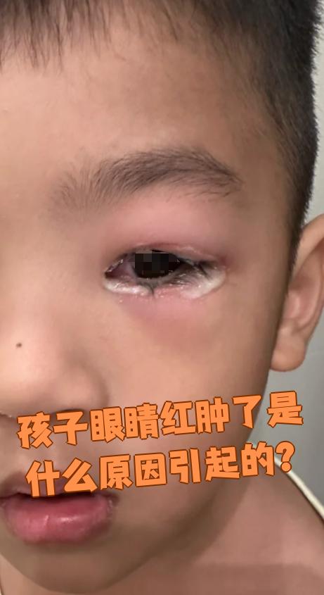 孩子眼睛红肿常见原因有以下几种: