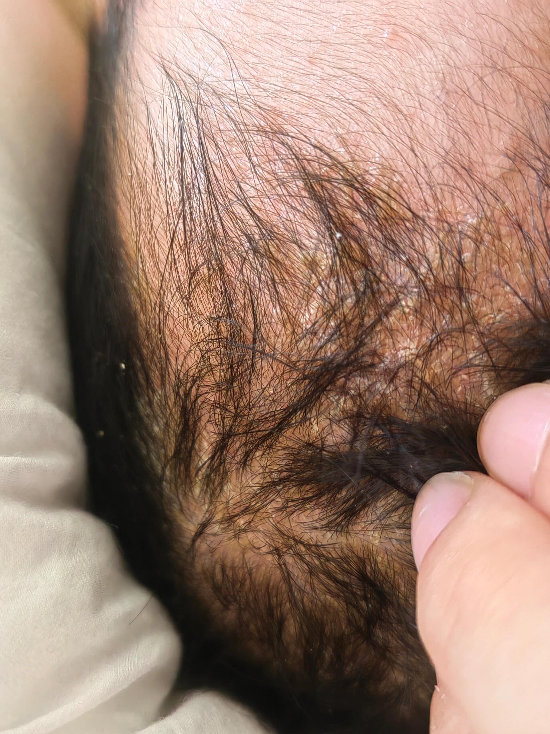 宝宝一月龄多,头皮就出现黄色结痂.