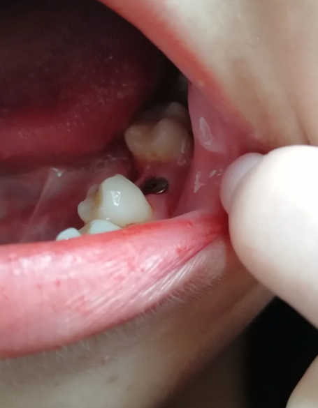 如果只是牙冠部分烂得厉害,但牙根还比较完整,这种情况通常不用拔牙