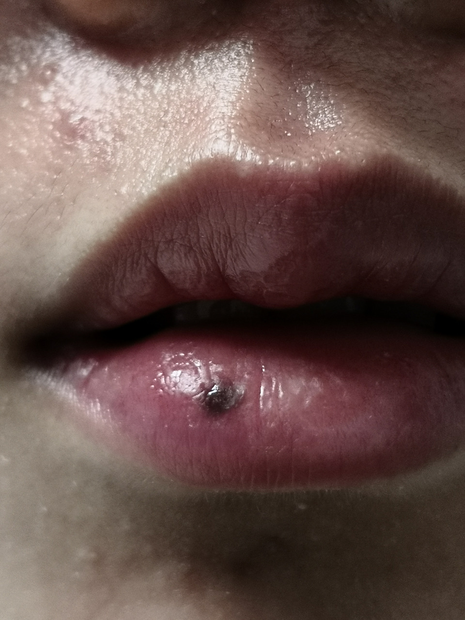 唇部色素痣和左侧咬肌部位的疤痕症状#解决皮肤问题专注皮肤美容