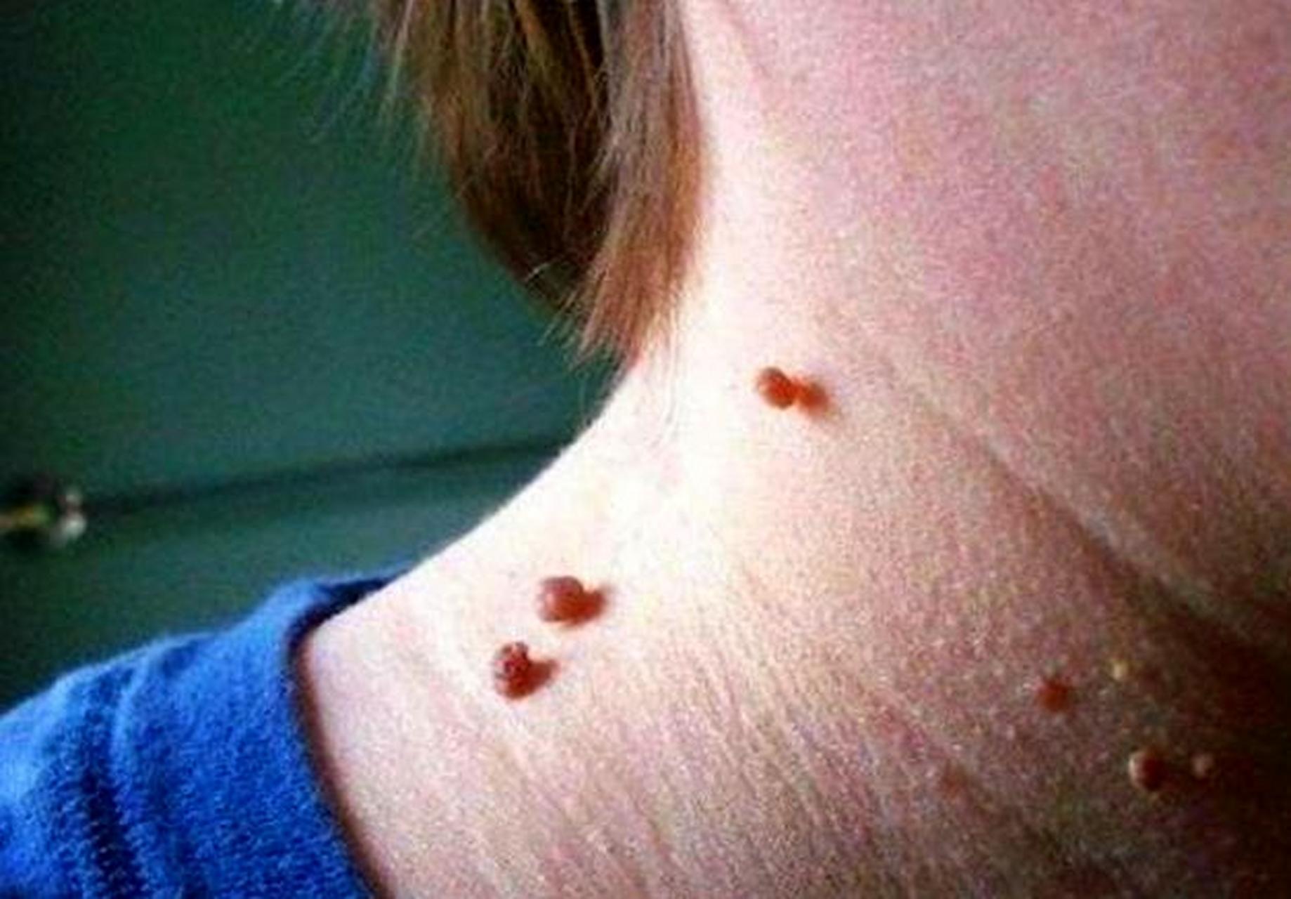 感染hpv病毒有哪些危害?