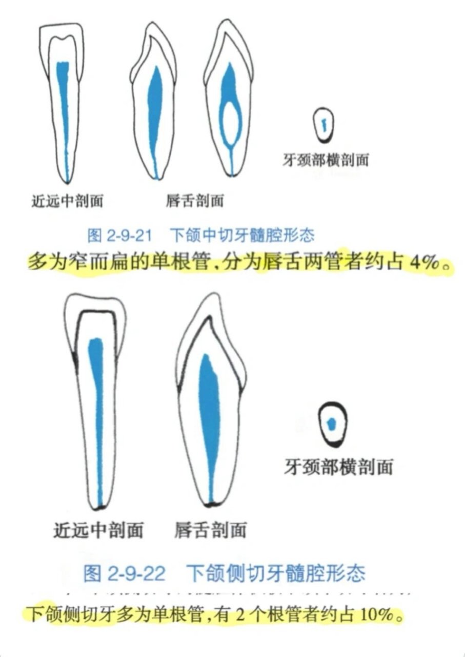 下颌六的开髓形态图片图片