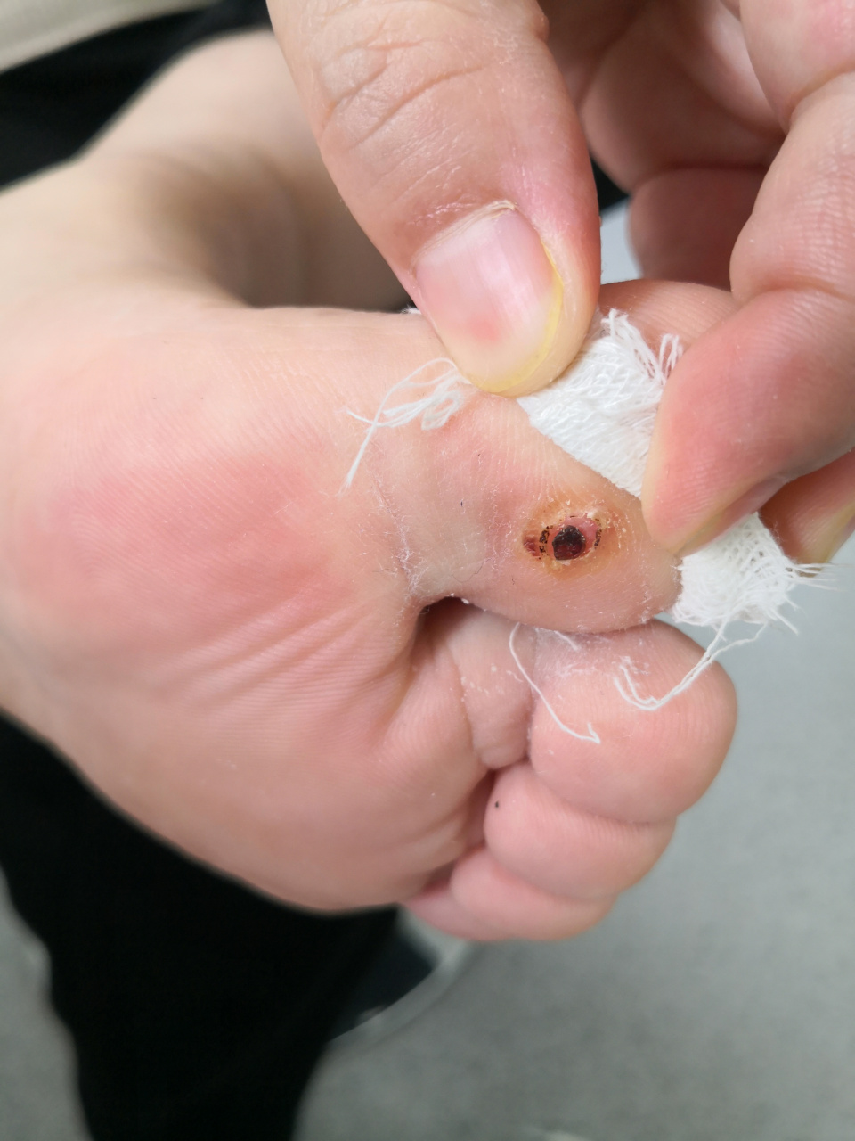 足底化脓性肉芽肿#皮肤