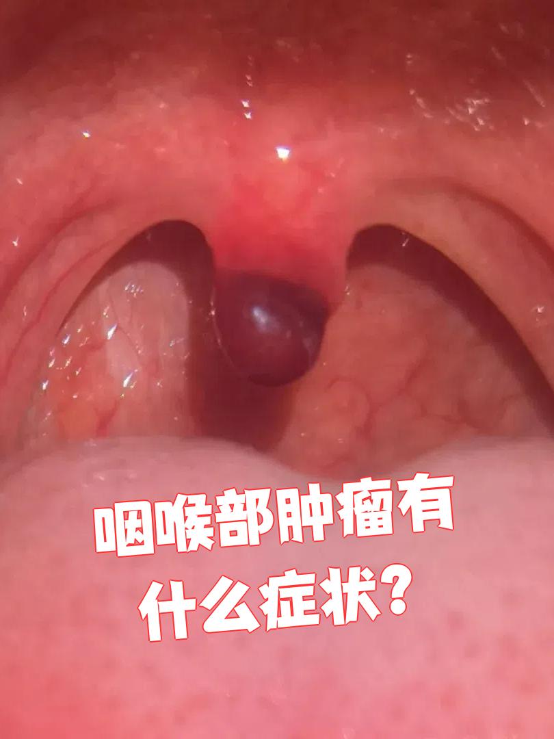 咽喉部肿瘤的症状因人而异,主要看肿瘤的性质和位置