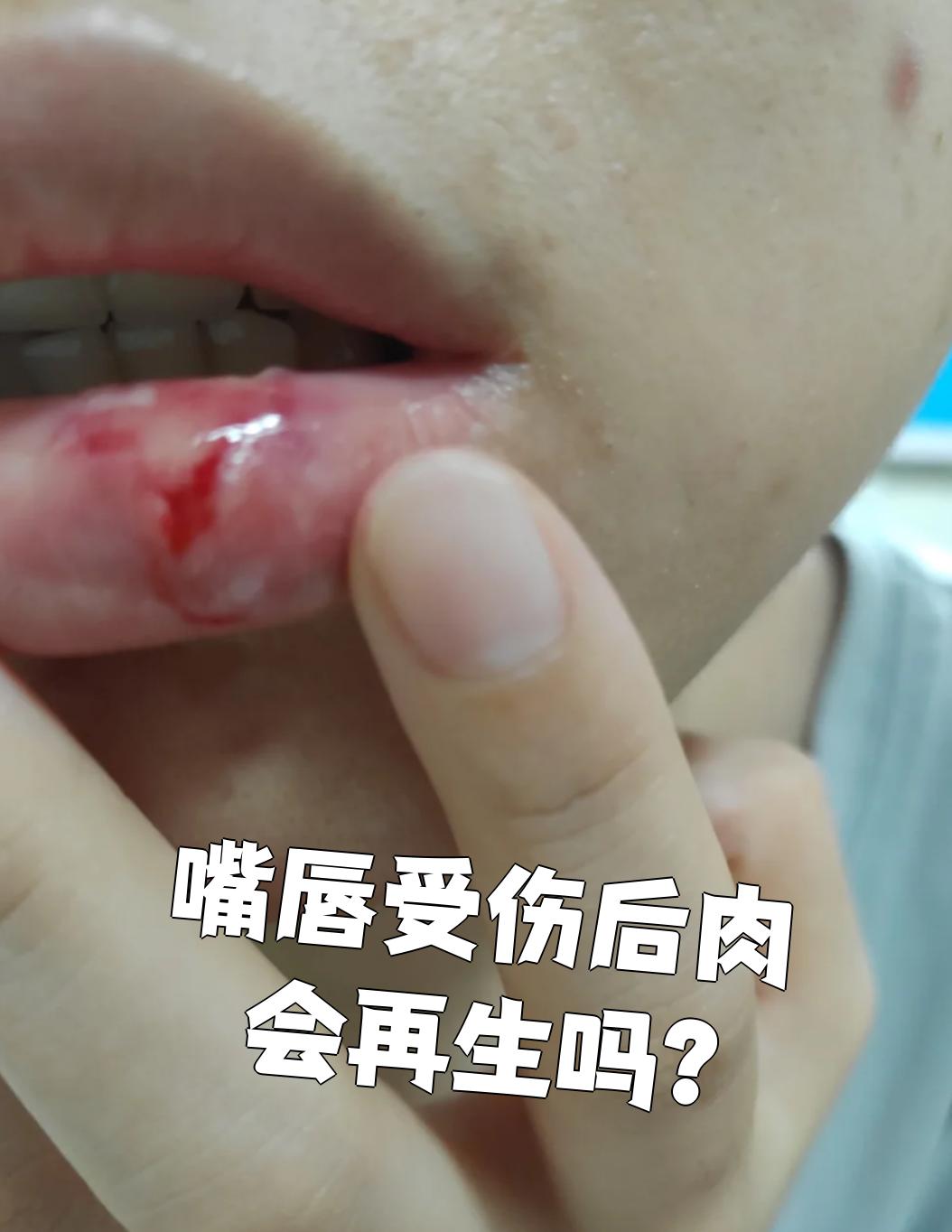 嘴唇受伤后能不能长回来,要看伤口大小