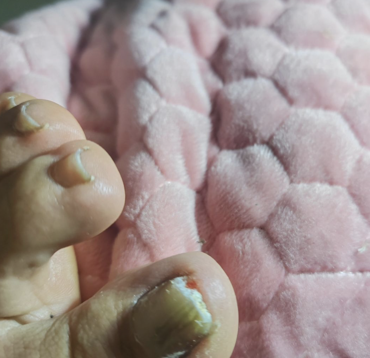 脚指甲变厚变黄里面都是粉末是哪个器官出现了问题?