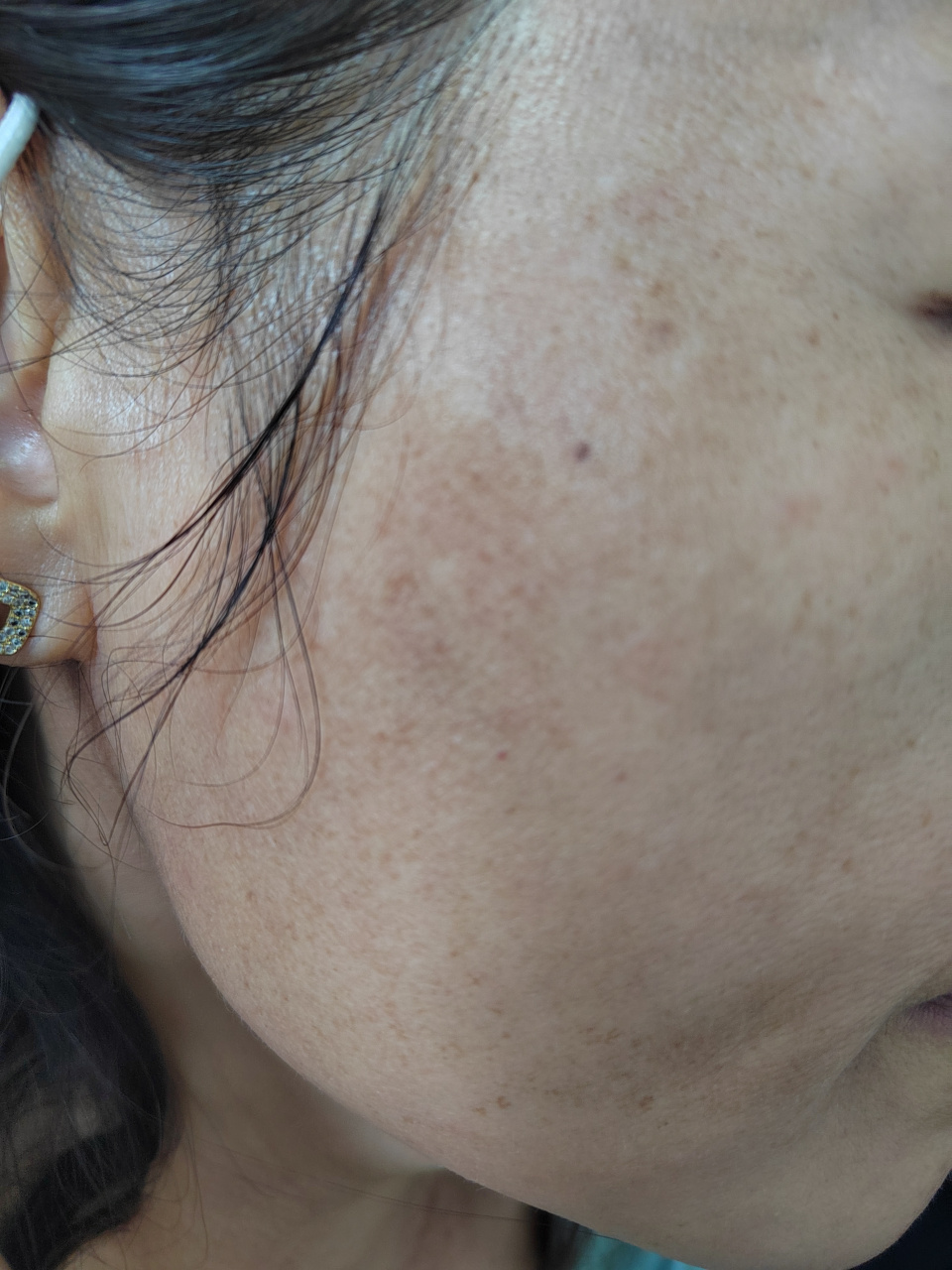 诊断黑变病.#解决皮肤问题专注皮肤美容##黑变病