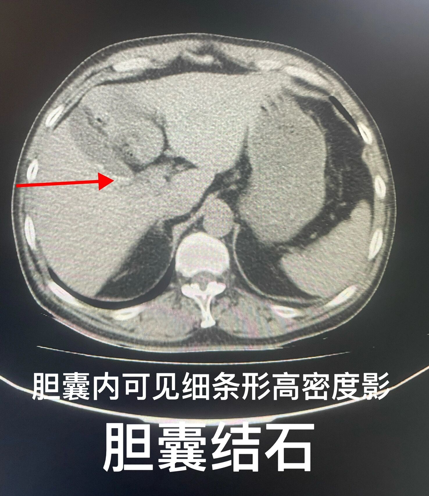胆系结石的ct表现💕💕💕 	 平扫:根据其化学成分不同,胆结石在