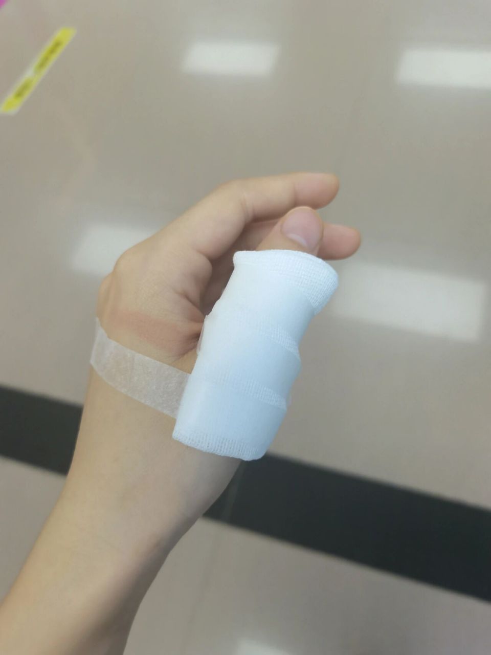 手背烫伤起泡了怎么办,要挑破吗 已经擦了烫伤药膏,原本没起泡,去洗了