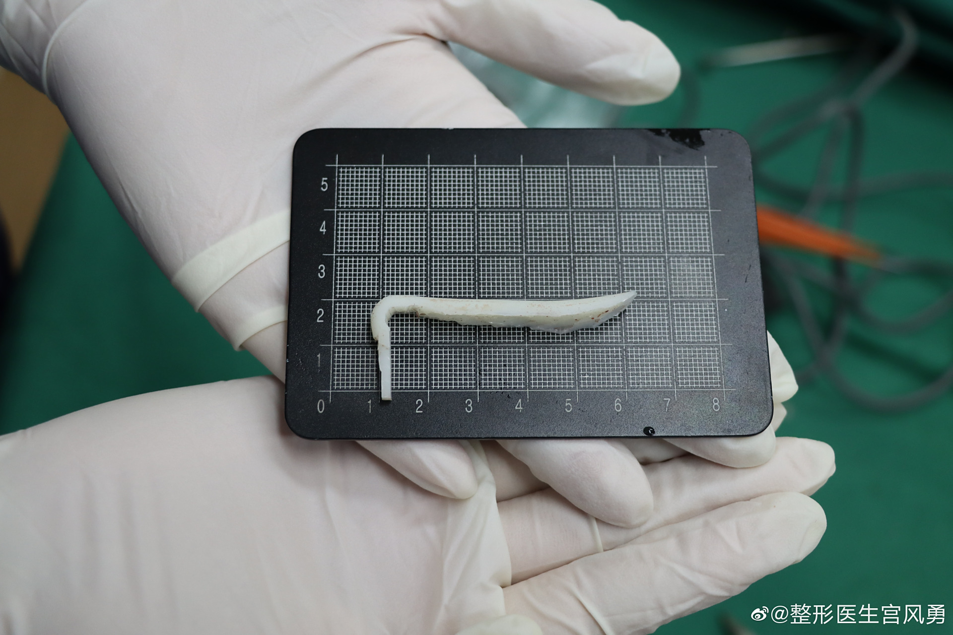 术前l型硅胶隆鼻,鼻修复 下颌缘吸脂术后10天,姑娘鼻子的肿胀情况比我