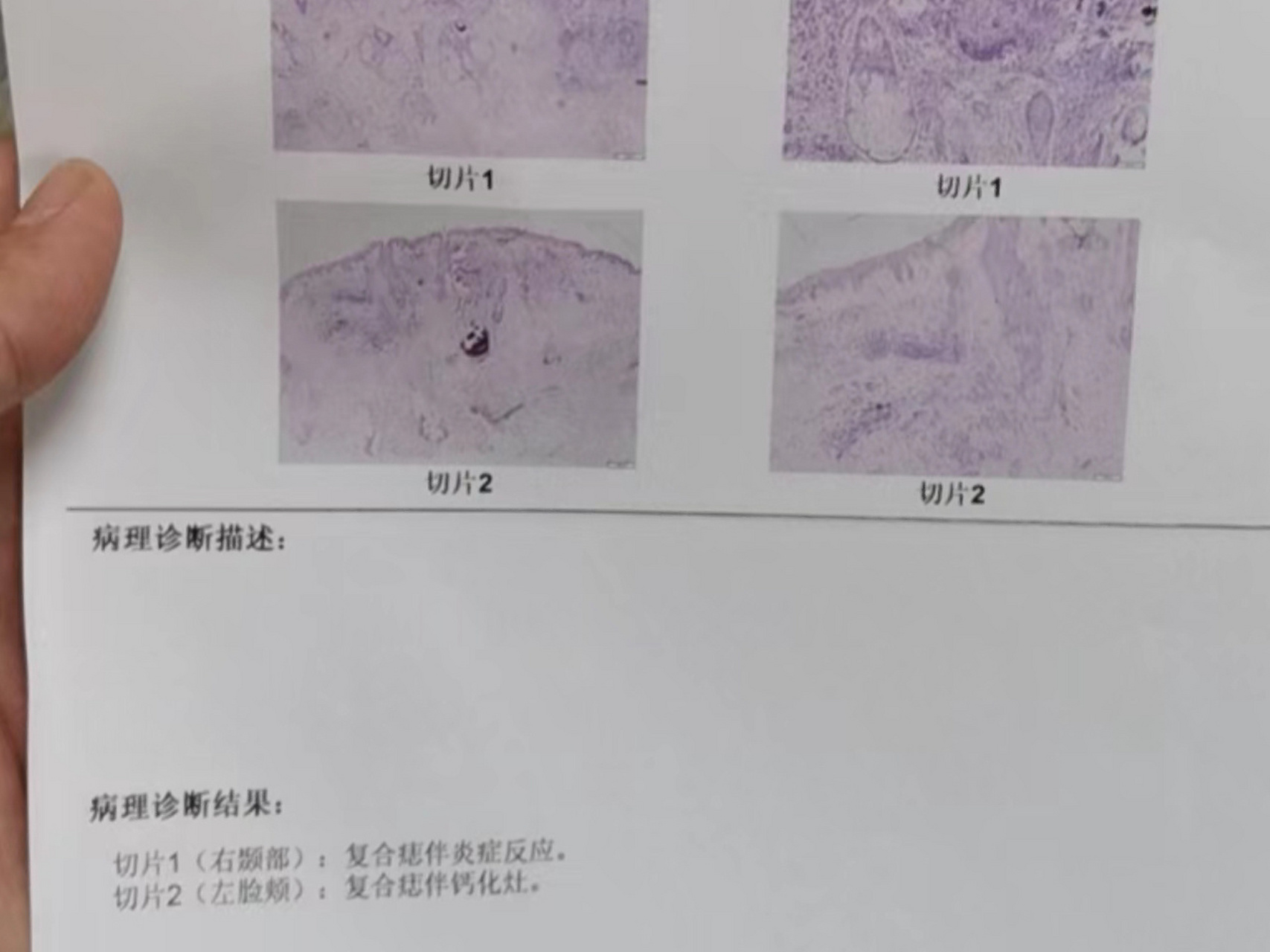 切痣病理出来了,没看懂