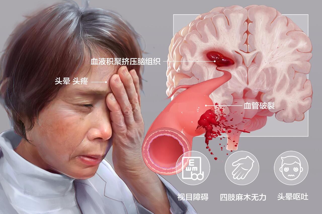在临床上经常有病人和家属问我,脑出血后,脑子里的血都吸收了,也没有