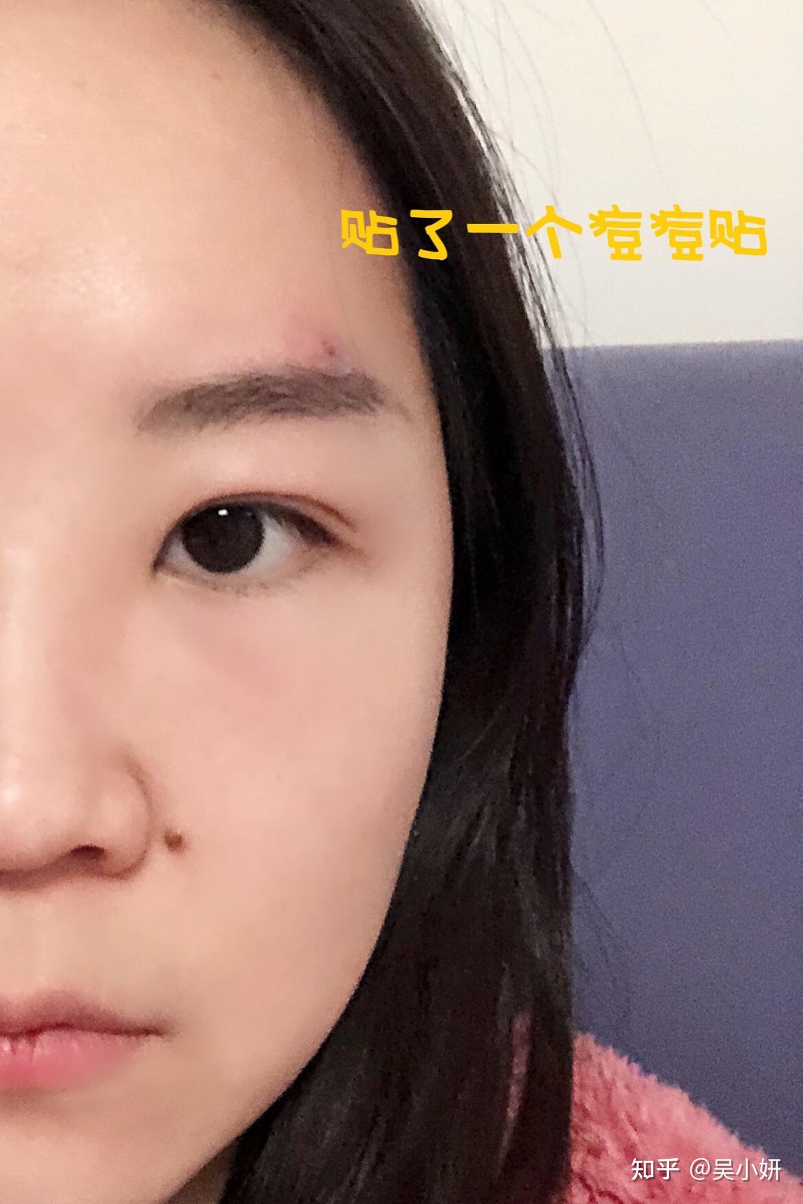 我的眉毛起了一个疖子