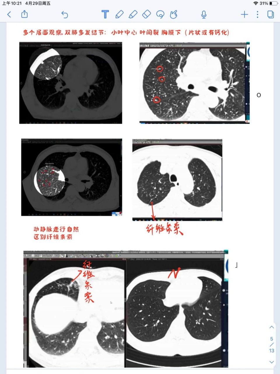 尘肺病ct图片图片