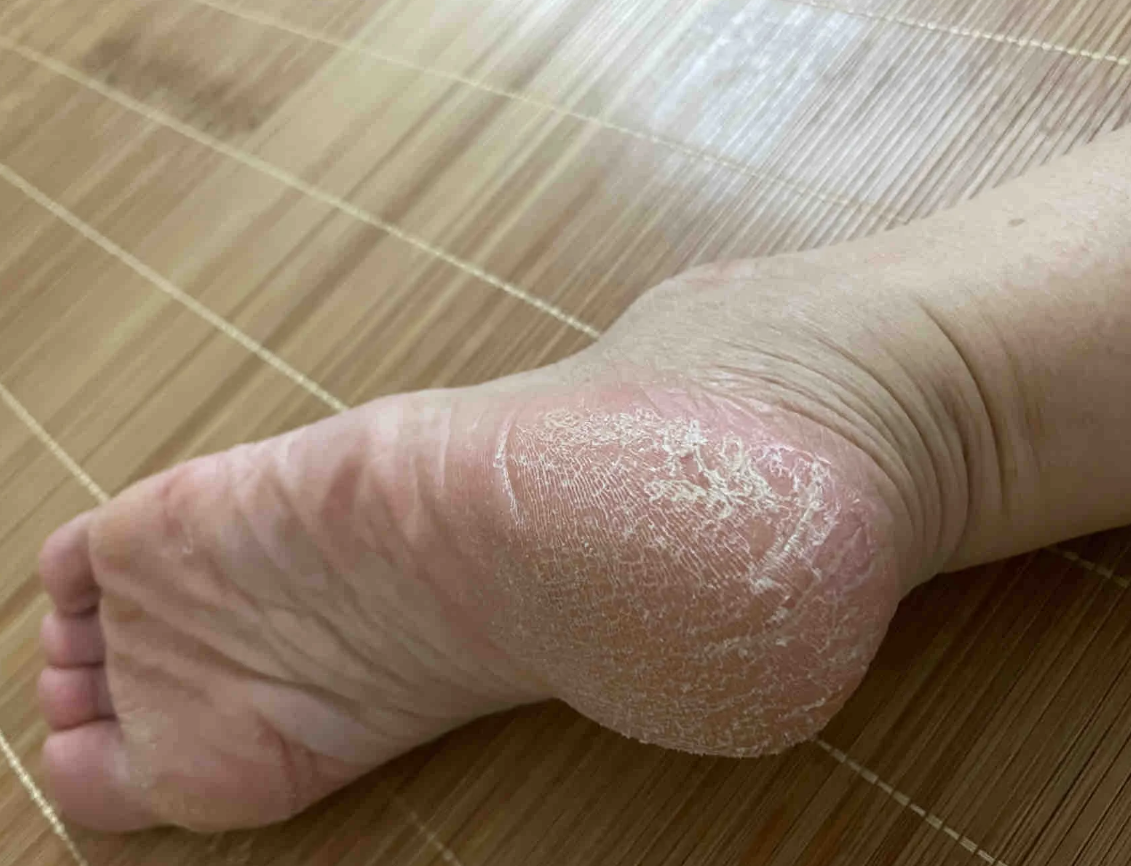 脚底板出现白色一块一块的东西,可能是足茧,足癣或白癜风引起的