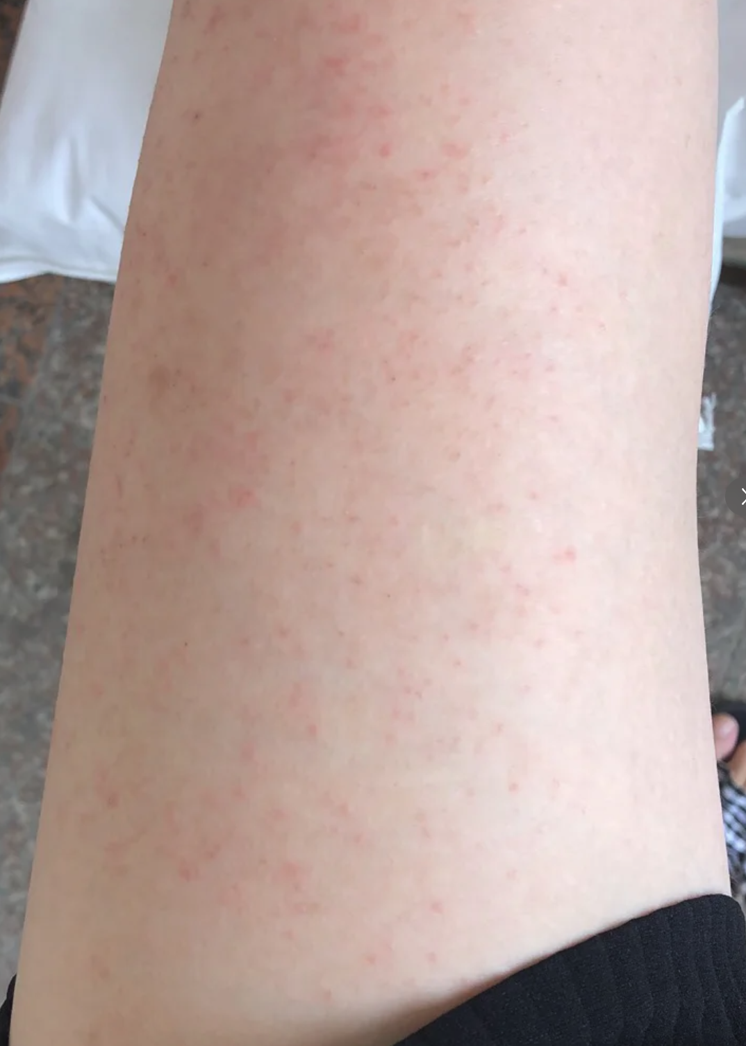 怀孕起了像蚊子包一样的红疙瘩怎么回事?