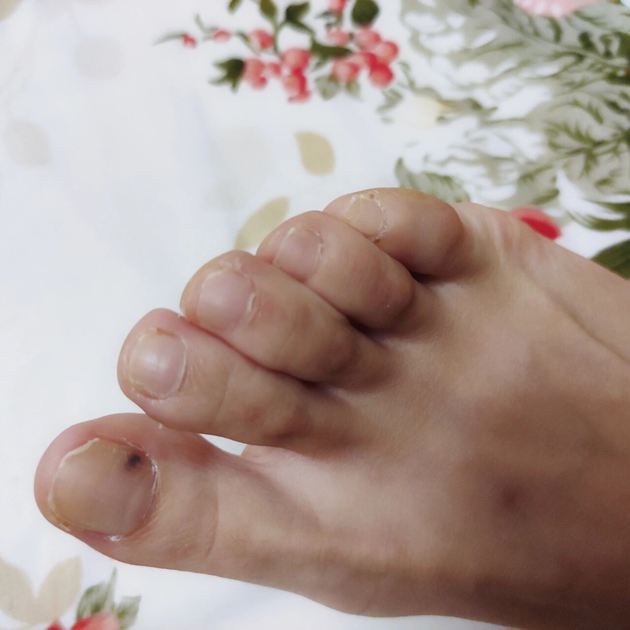 脚指甲里面突然黑了一块 今天突然发现脚指甲里面突然黑了一块,百度有