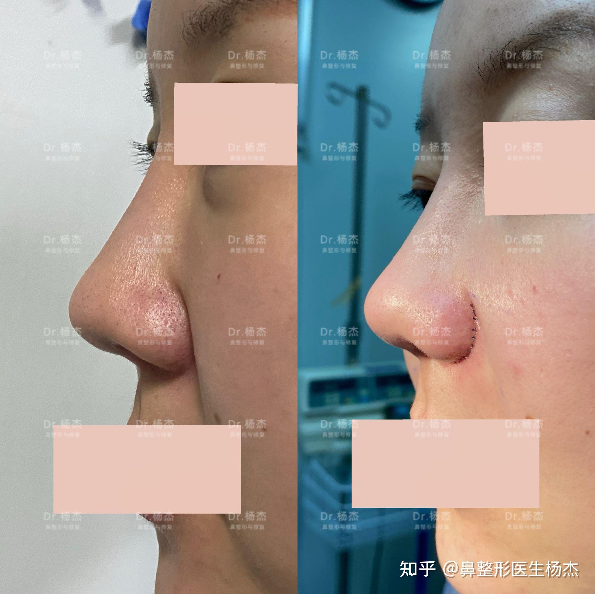 外切鼻翼缩小鼻基底凹陷填充