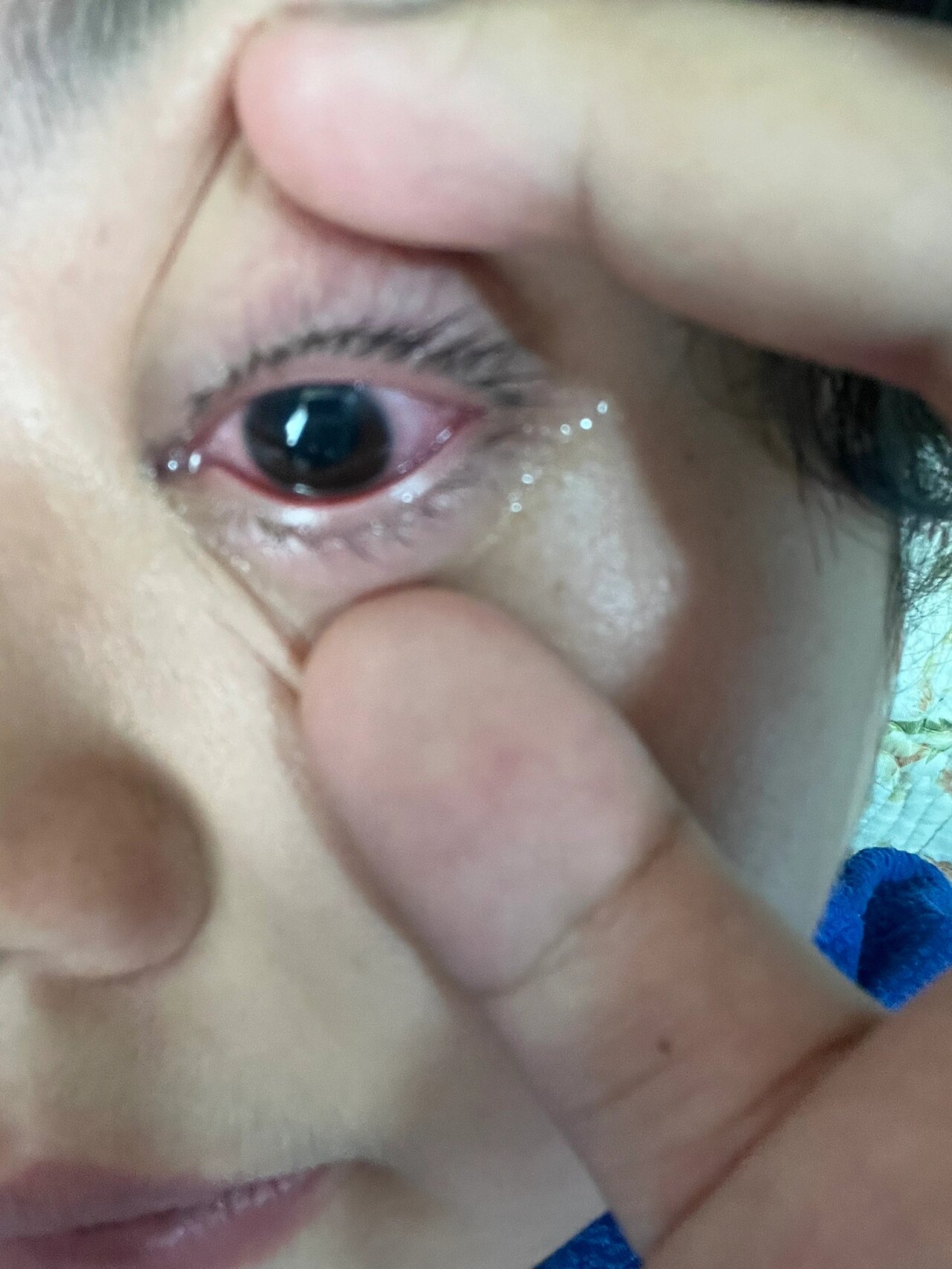 早上醒来左眼几乎失明,什么都白茫茫一片,去同仁复查,眼压三十多,医生