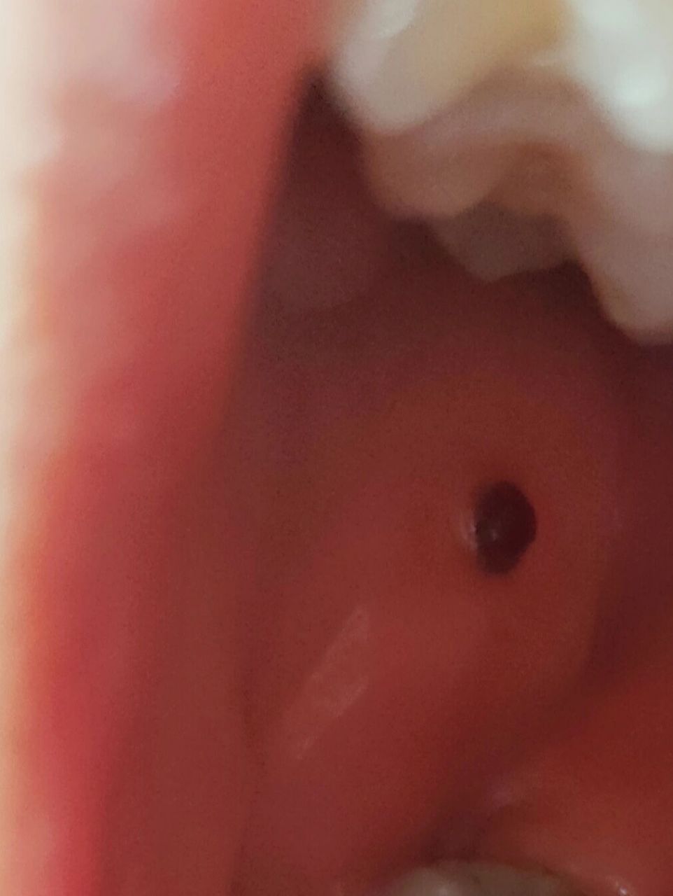 嘴巴壁上长了个小血泡 吃了包苏打饼,后面吃饭的时候鬼使神差舌头摸了