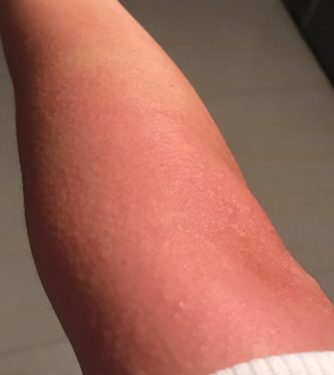 蜂蜜水过敏(吃蜂蜜过敏怎么办)