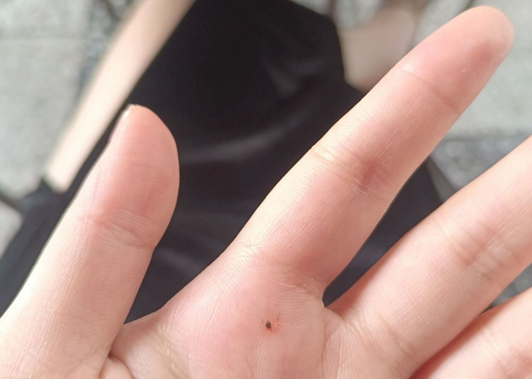 剧毒的南方蠓虫!能痒一个星期!留疤几年!