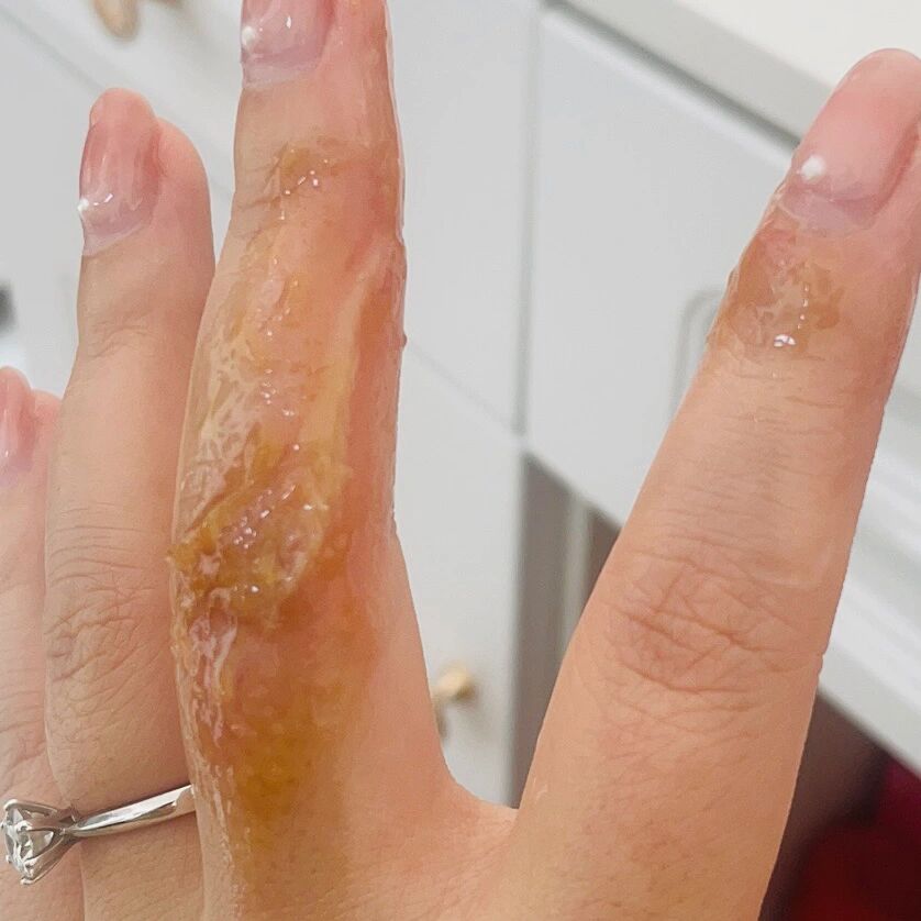 被热熔胶烫伤手的3·8节日