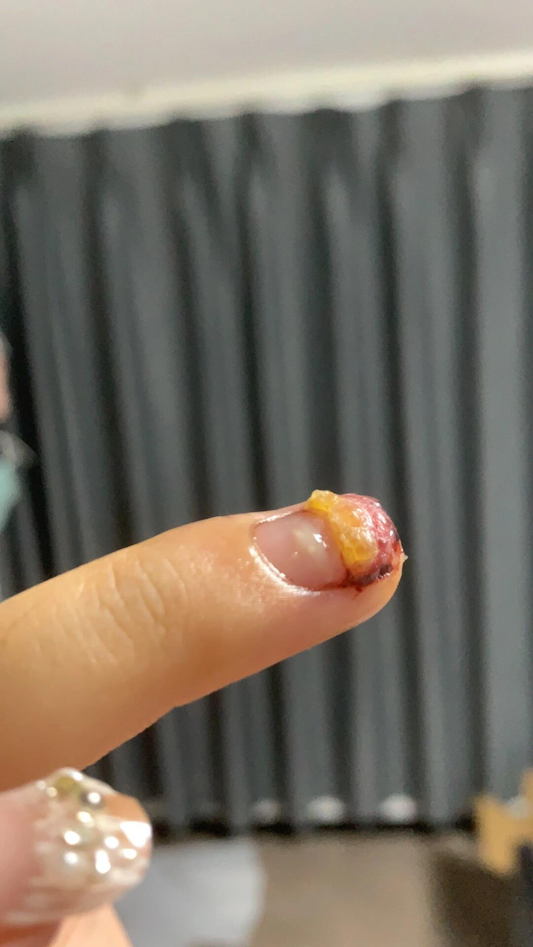 历时不到两个月,我的指甲终于长出来