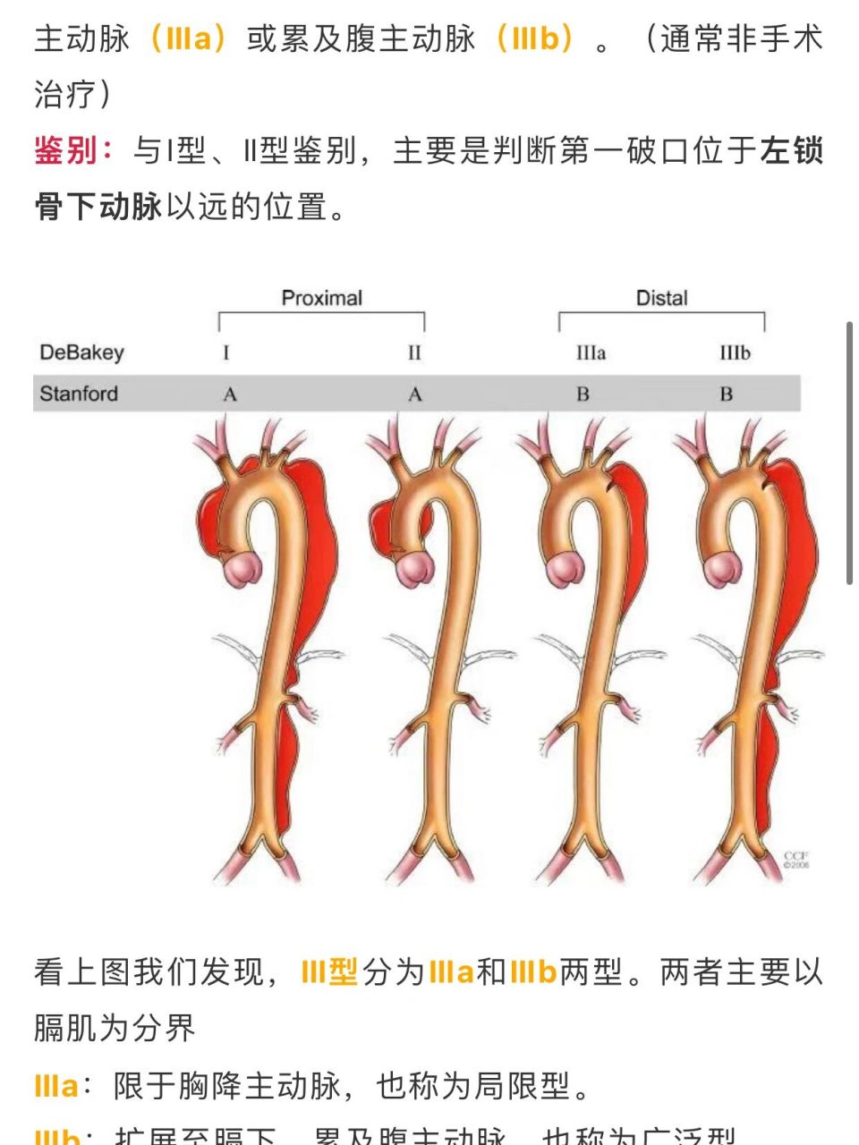 主动脉夹层分型