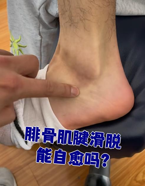 腓骨肌腱滑脱能不能自己好,主要看严重程度