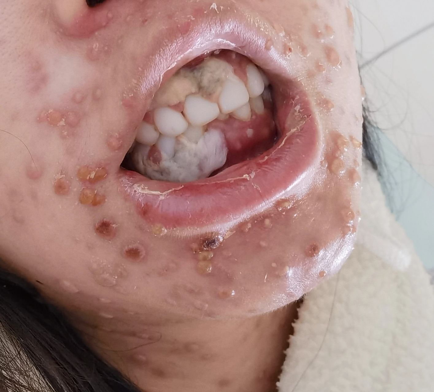 孕中期得水痘了😭 刚步入孕中期没多久,染上了水痘,牙龈上先长了颗