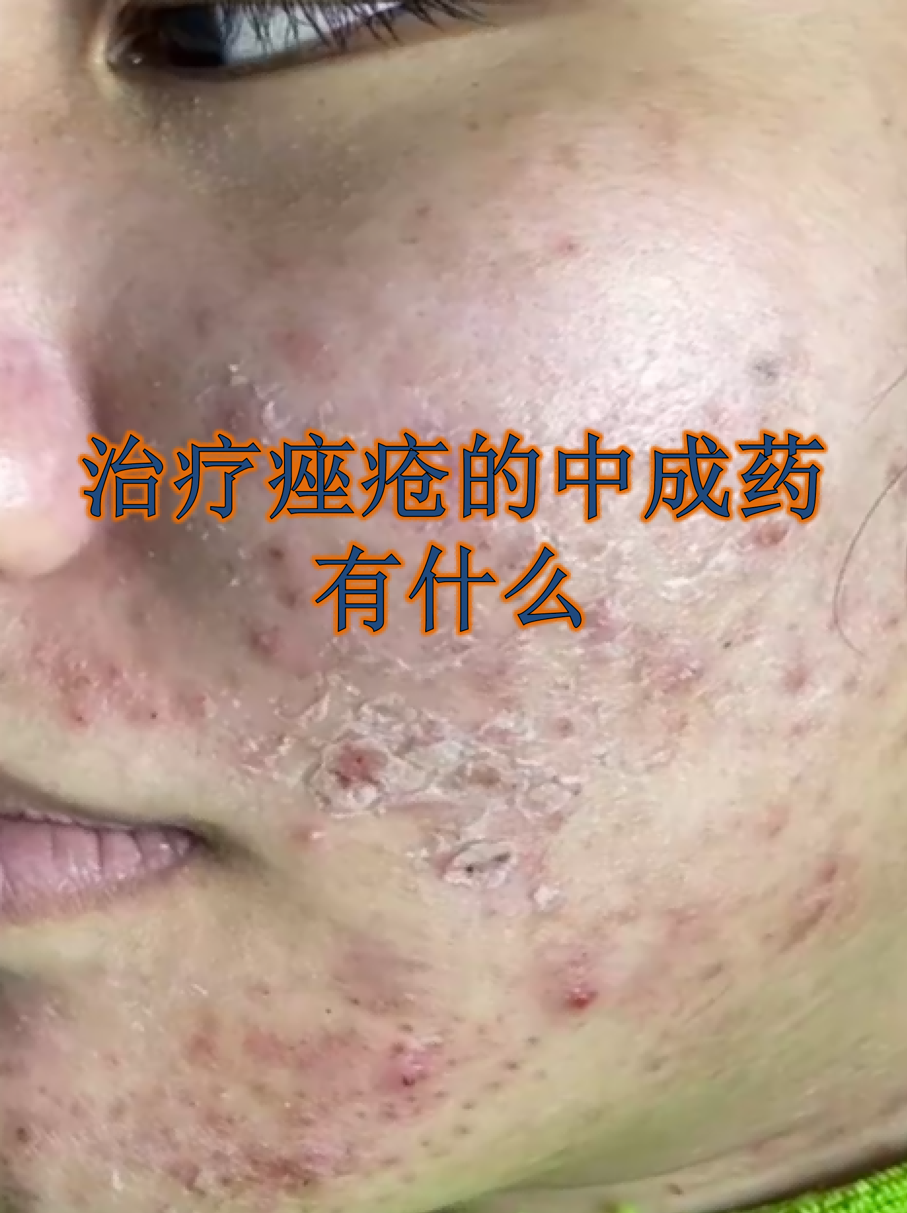 治疗痤疮的中成药有什么