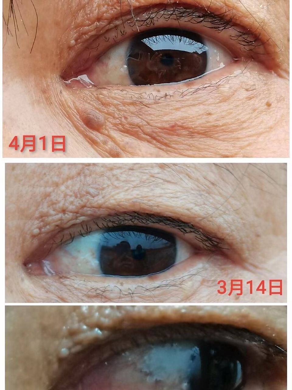 胬肉改善了,眼睛明亮了 ​ ​ ​‮妈的庞小‬妈胬肉‮个