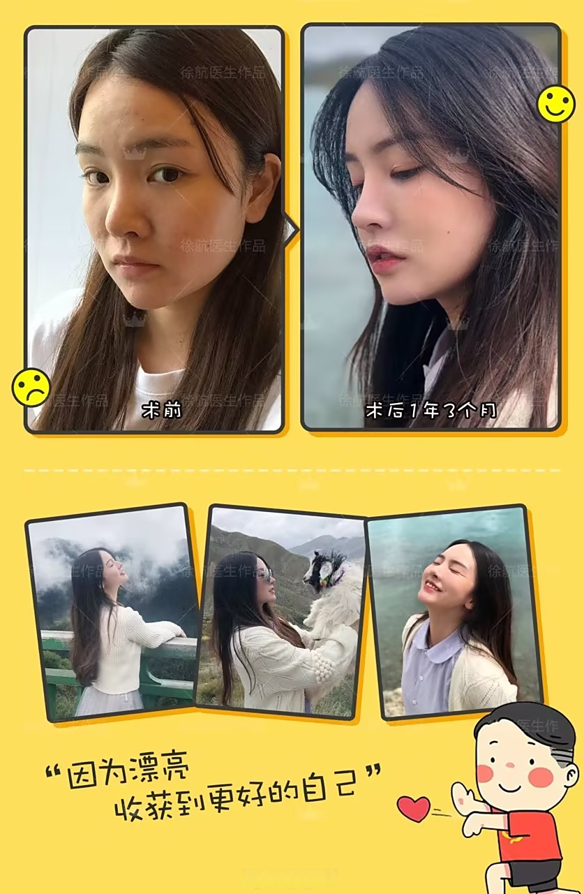 这种肉肉的蒜头鼻,经过鼻综合整形修复后,可以精致,微翘,鼻基底饱满.